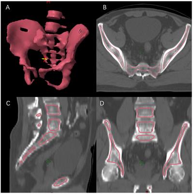 Retrospective cohort study for thrombocytopenia during concurrent chemoradiotherapy for rectal cancer